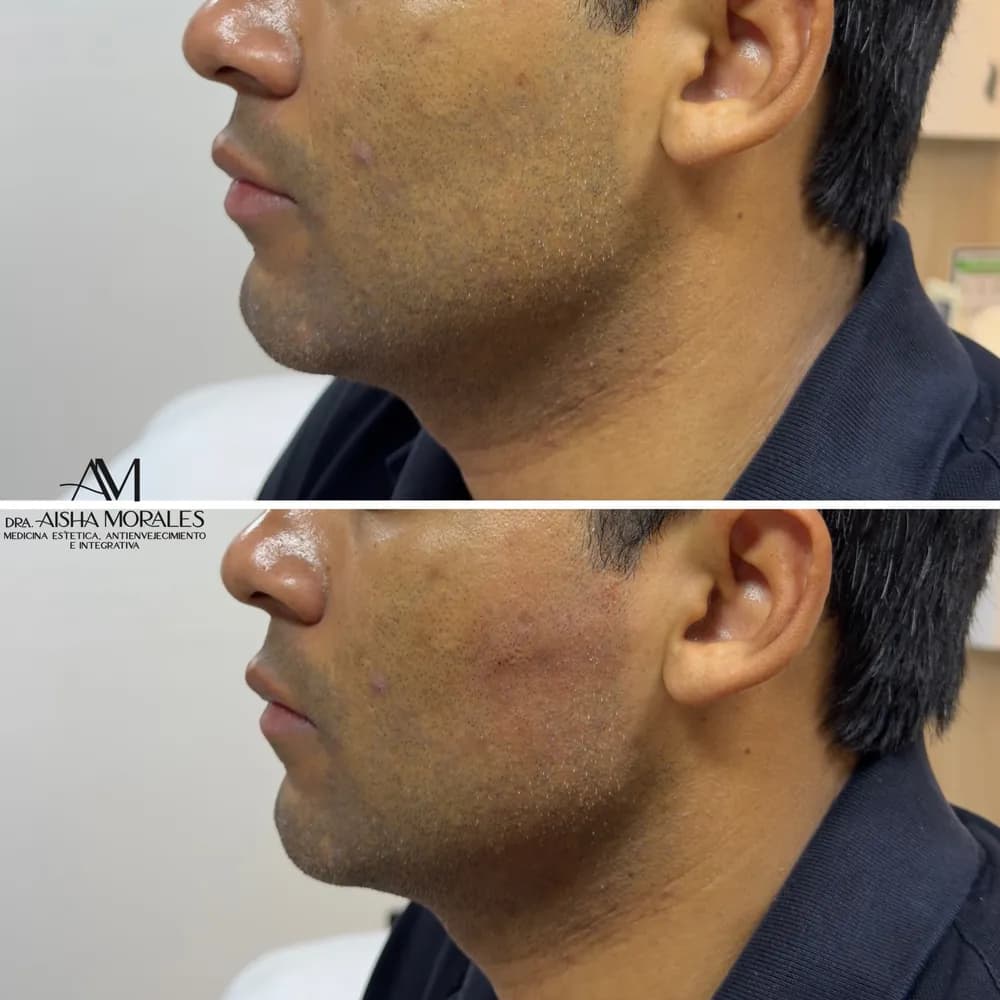 Antes y después: Definición mandibular