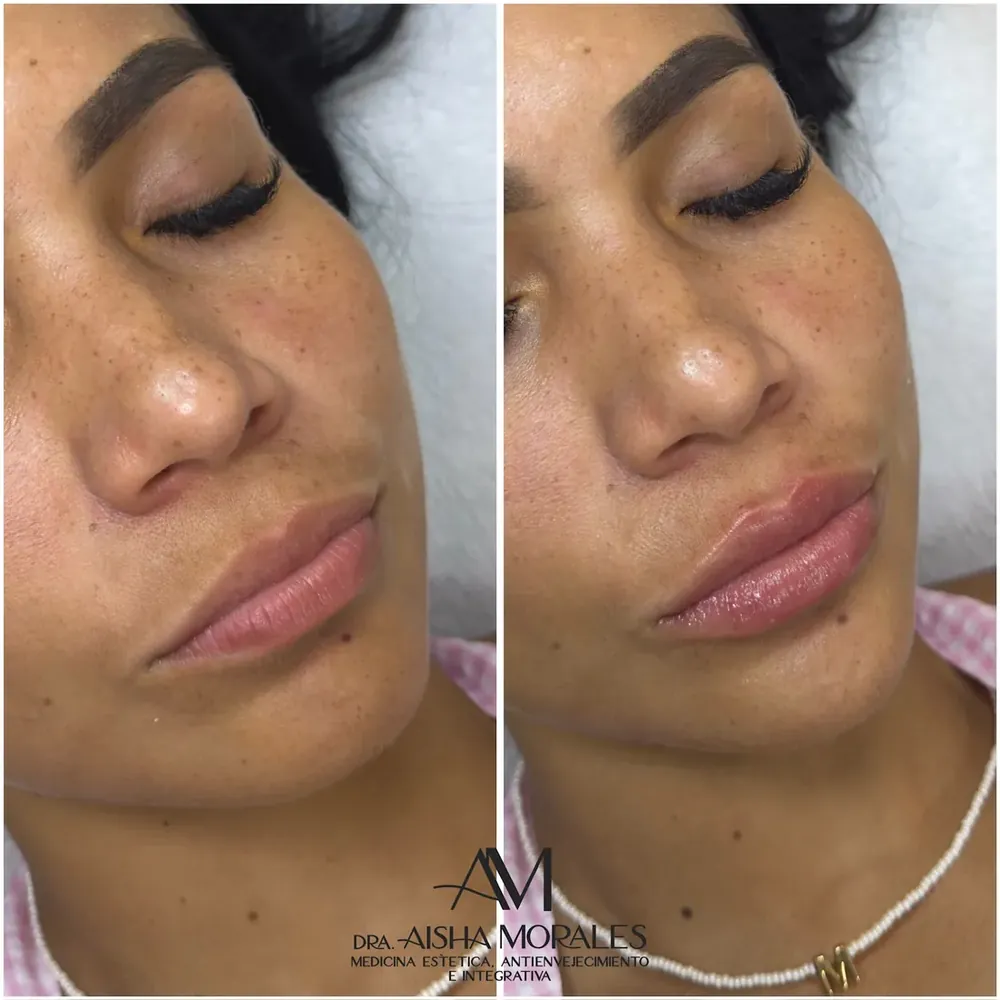 Antes y después: Labios