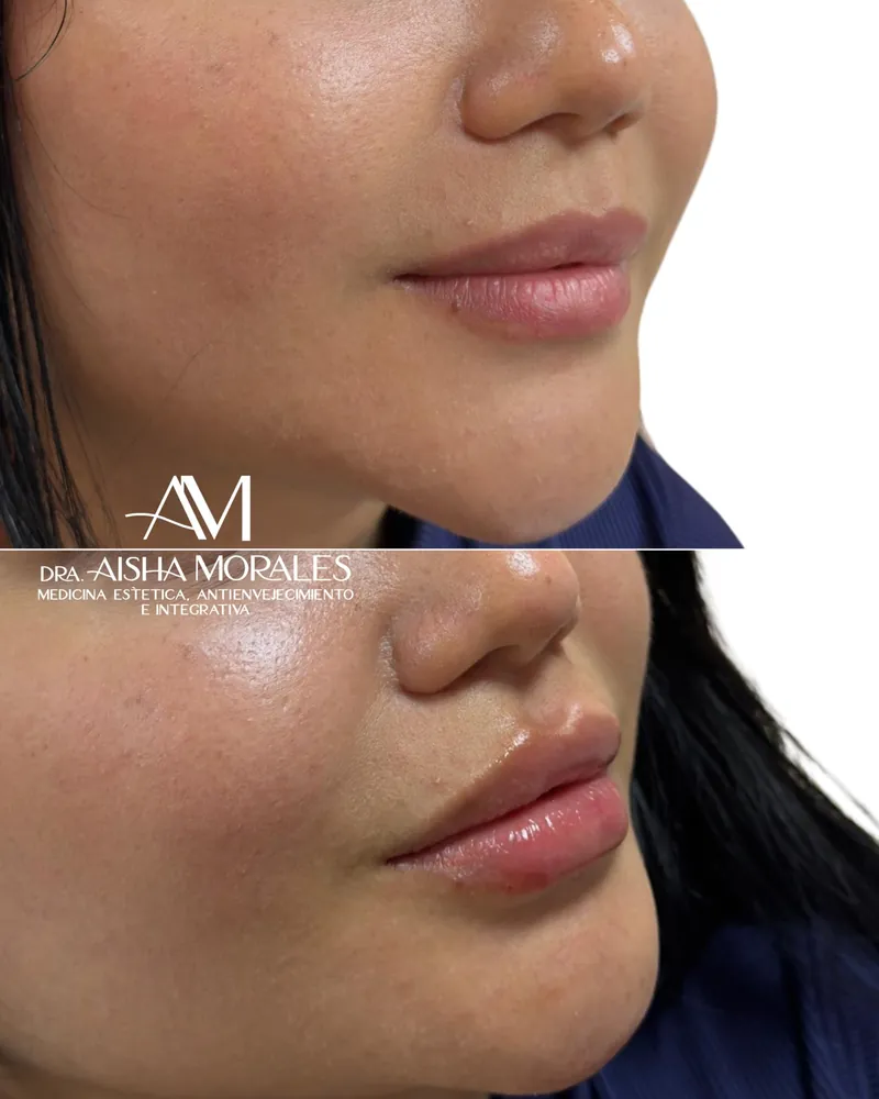 Antes y después: Labios