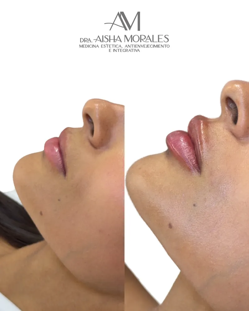 Antes y después: Labios