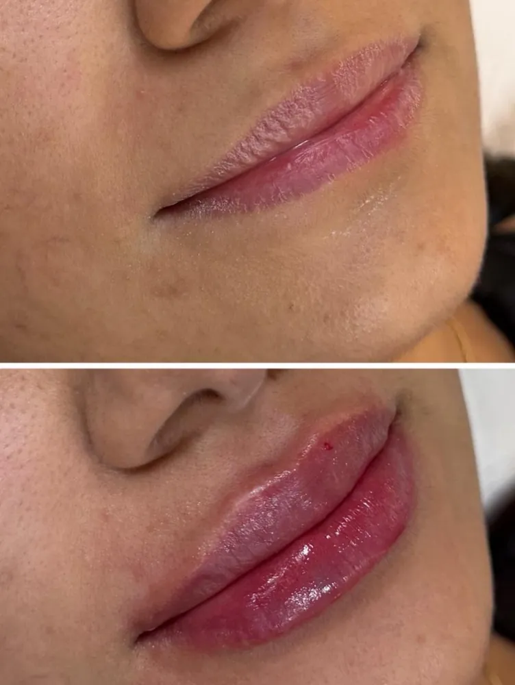 Antes y después: Volumen de labios