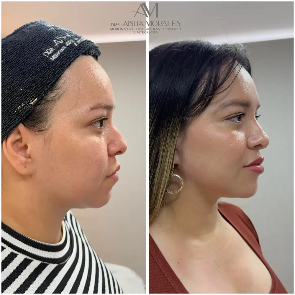 Antes y después: Armonización de perfil