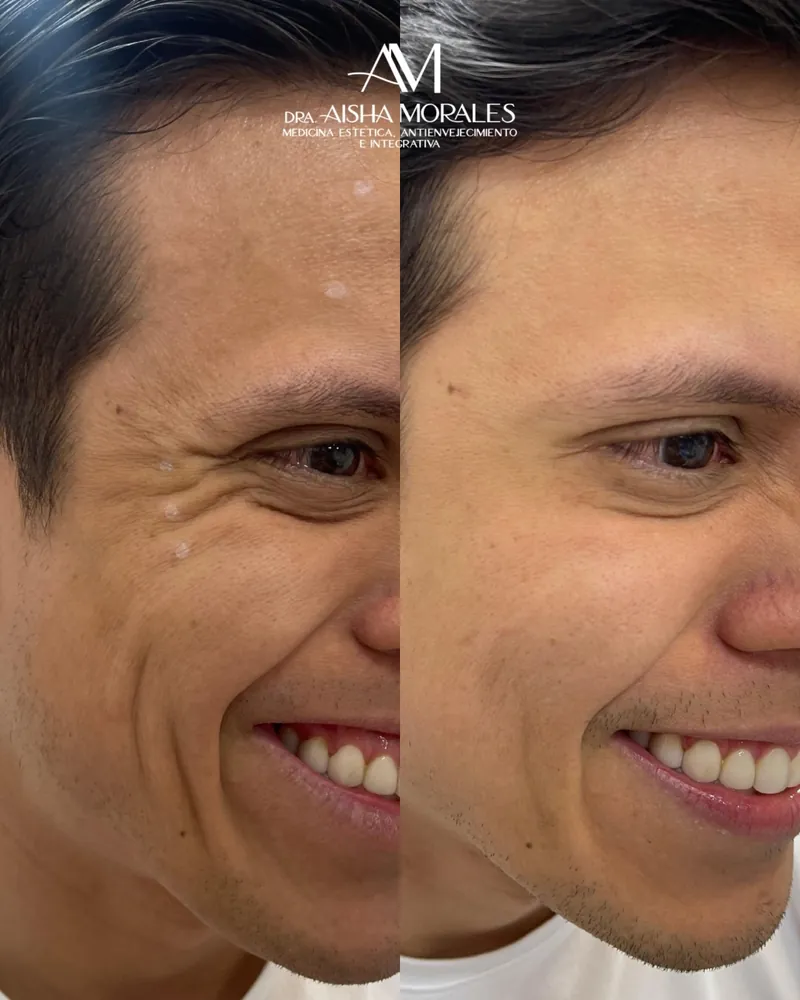 Antes y después: Toxina y sonrisa gingival